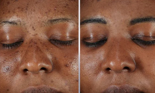 Le Moyen Le Plus Facile & Naturel pour Traiter L'Hyperpigmentation & Unifier Son Teint